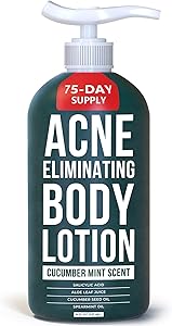 TreeActiv Acne Eliminating Body Lotion 8oz Review