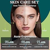 Onkessy Tea Tree Oil Acne Treatment Skin Care Set — image 4