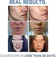 Clearogen Acne Lotion with Benzoyl Peroxide 1.8 fl oz — image 4