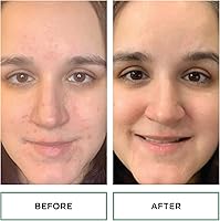 Replenix Gly-Sal Clarifying Acne Pads, 60 Count — image 4