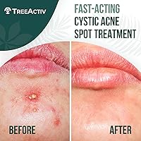 TreeActiv Cystic Acne Spot Treatment 0.5oz — image 2
