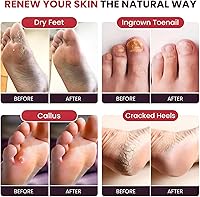 Foot Cure Muscle Care Foot Soak with Epsom Salts – 16 oz (Pack of 2) — image 5