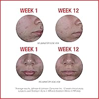 Neutrogena Stubborn Acne AM Face Treatment with Benzoyl Peroxide & Stubborn Marks PM Treatment with Retinol SA — image 6