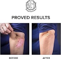 Beauty Facial Extreme Keratosis Pilaris Exfoliating Body Lotion 12% Lactic Acid 400mL — image 3