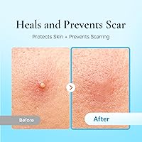 DERMAKR Discreet Acne Pimple Patch 4 Packs — image 4