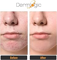 Dermlogic Acne Treatment Pads - 2% Salicylic Acid, Exfoliating, Unscented — image 7