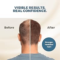 HAIRMETTO Saw Palmetto Extract Serum for Hair Loss - 4oz — image 3