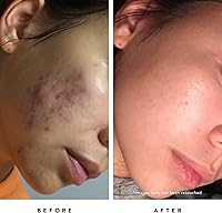 HERBIVORE Blue Tansy BHA & Enzyme Pore Refining Mask 60mL — image 4