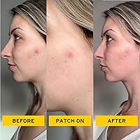 No Bad Stuff Healing Acne Patches 72 CT — image 3