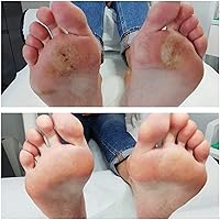 Imperial Feet 2 in 1 Foot Cream for Dry Cracked Heels 2.5oz — image 9