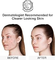 Beauty Facial Extreme Acne Treatment Pads 60 Count — image 3