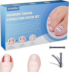 Asinkiher Titanium Alloy Ingrown Toenail Treatment Kit Review