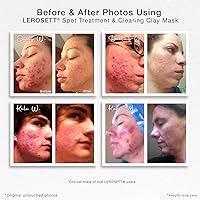 LEROSETT Facial Clay Mask for Acne, Oily Skin, 3.8oz — image 2