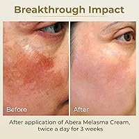 ABERA Melasma Cream Premium Version 0.7 Oz — image 4