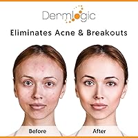 Dermlogic Acne Treatment Pads - 2% Salicylic Acid, Exfoliating, Unscented — image 3