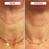 Glov Beauty Micro Infusion System for Face & Lips – 0.25mm 24k Gold Stamp with Serum — image 4