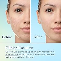 Differin Acne Skin Care Kit — image 11