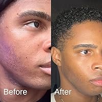 Shield Acne System for Men and Boys - 2 Month Kit — image 7