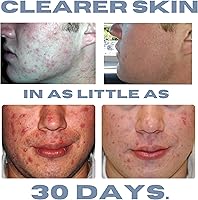 Clearogen Sensitive Skin Sulfur Acne Lotion 1.8 FL Oz — image 5