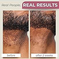 Dual-Shave 2-in-1 Acne Facial Wash + Medicated Shaving Cream 6oz — image 8