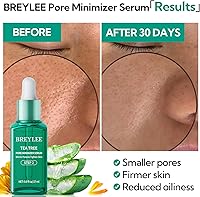 BREYLEE Blackhead Remover Mask & Pore Minimizer Serum Set — image 5
