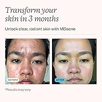 MDacne Acne Treatment Cream 2.5% - 0.5 fl oz — image 3