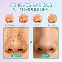 VOYOR BR410 Blackhead Remover Pore Vacuum — image 3