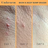 SweetSpot Labs Bikini & Body Bump Eraser 2-Pack — image 4