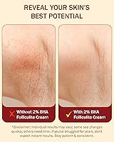 e70 Folliculitis Cream – 4 oz — image 5
