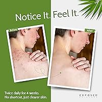 Exposed Skin Care Body Acne Wash 12oz — image 2