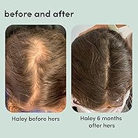 hers Triple Threat Shampoo, Conditioner and Minoxidil Set — image 6