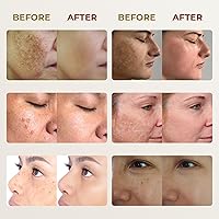 ABERA Melasma Cream Premium Version 0.7 Oz — image 7