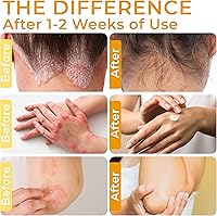 Rida Psoriasis Cream for Itchy Scalp, Face & Body, XL Size — image 3