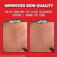 THAYERS Witch Hazel Blemish Cleanser, 4 Ounce — image 4