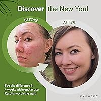 Exposed Skin Care Acne Treatment Kit — image 3