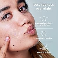 OMMA Korean Microdart Acne Patch 14mm (18 Count) — image 3