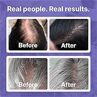 Shapiro MD Hair Growth Experts Minoxidil 2% Topical Solution for Women (3 Month) — image 4