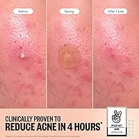 PEACE OUT Acne Healing Dots 60 Count — image 3