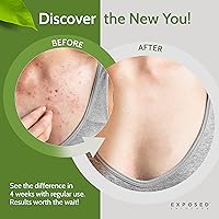 Exposed Skin Care Body Acne Wash 12oz — image 3