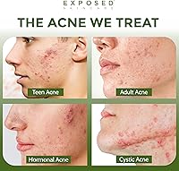Exposed Skin Care Acne Treatment Kit — image 2