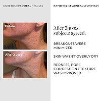 Murad Acne Control Rapid Relief Acne Sulfur Mask 2.5oz — image 5