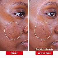 First Aid Beauty Acne Pads for Face 2% Salicylic Acid 60-ct — image 4