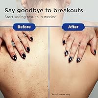 Clear 2 Perfection Acne Treatment Kit — image 5