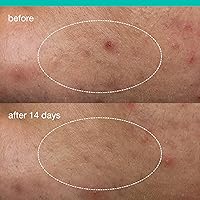 Dermalogica Deep Acne Liquid Patch 0.5 fl oz — image 6