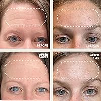 Dermaclara Silicone Facial Patches - Anti-Wrinkle Patches for Frown, Smile Lines & Forehead — image 5