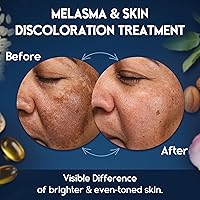 Pharmlitalia Melasma Treatment Cream for Face & Body — image 3