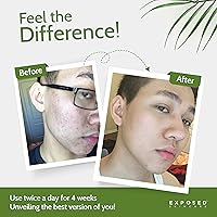 Exposed Skin Care Acne Treatment Kit — image 4