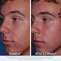 Obagi CLENZIderm M.D. Pore Therapy Exfoliating BHA Toner 5oz — image 4