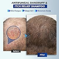 Oely Antifungal Shampoo for Seborrheic Dermatitis, Folliculitis & Scalp Psoriasis, 10.1 Fl Oz — image 5