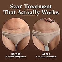 Nemah Restorative Scar Treatment for C Section Recovery 1 oz. — image 2